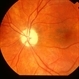 Optic Atrophy Optic Atrophy